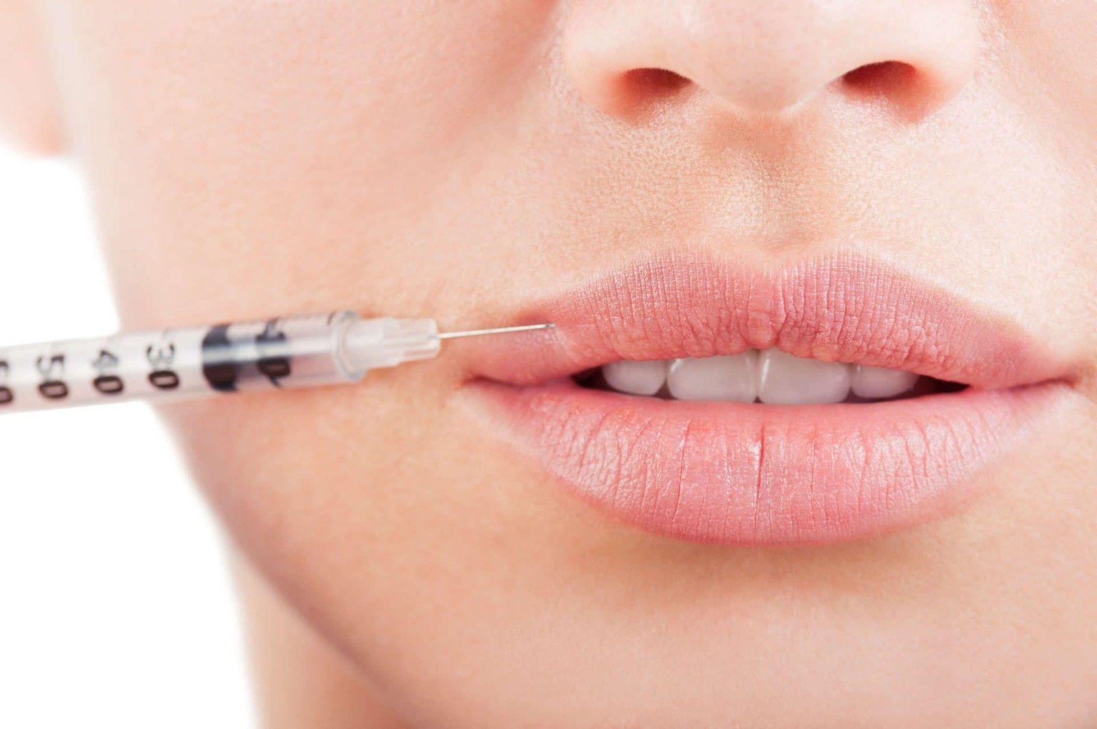 Preenchimento Labial: uma beleza com naturalidade